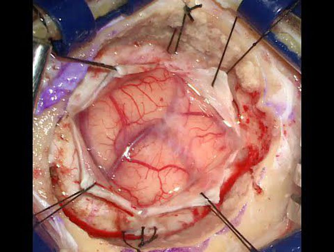 Brain hemorrhage:  Surgical management of spontaneous brain hemorrhage resulting in coma
