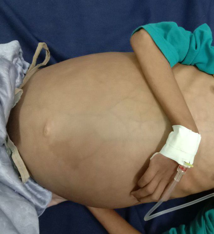 #ascites #Excess abdominal fluid
Also called: Ascites