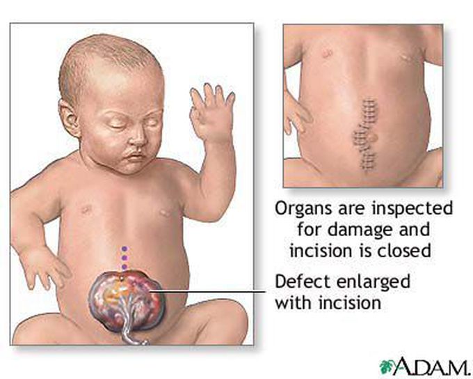 What are the signs of omphalocele?