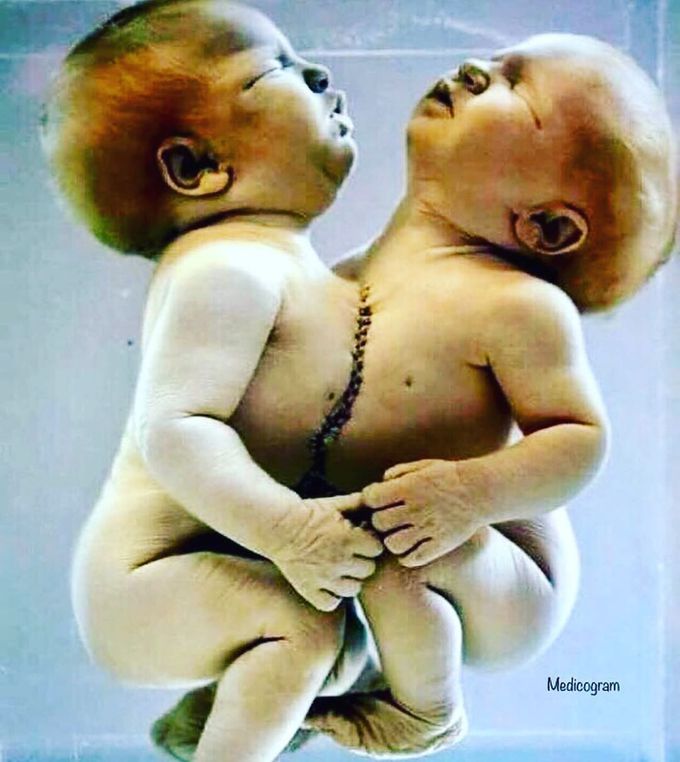 Conjoined Twins 