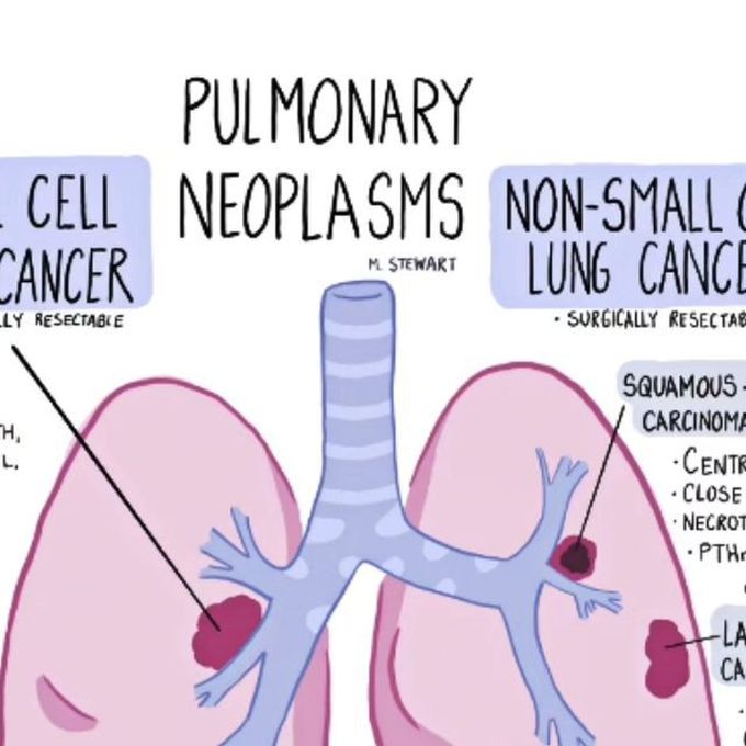 Pulmonaire neoplasm