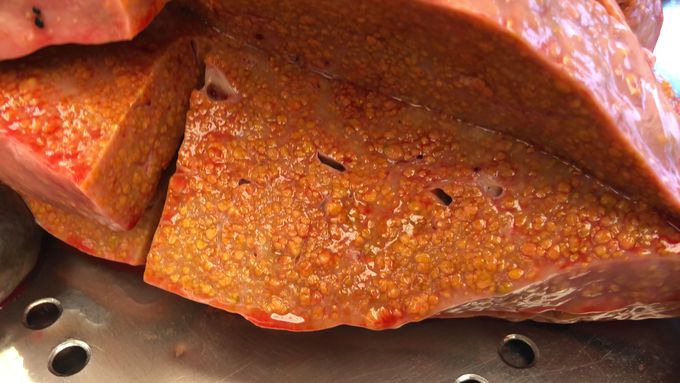 Severe alcoholic liver cirrhosis