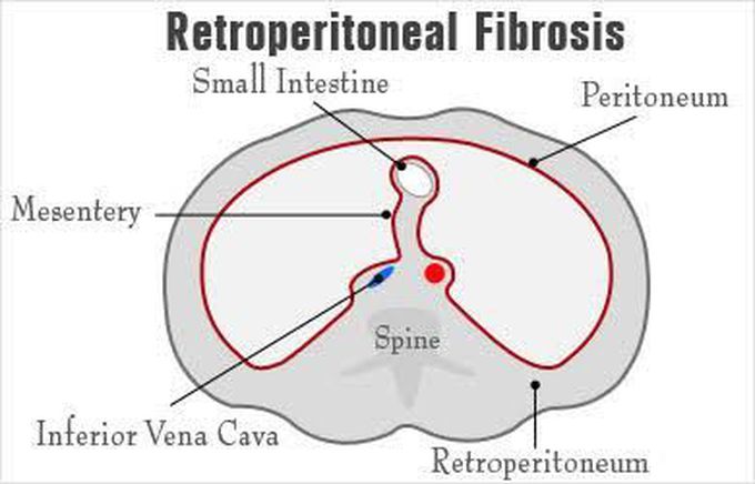 Retroperitoneal fibrosis