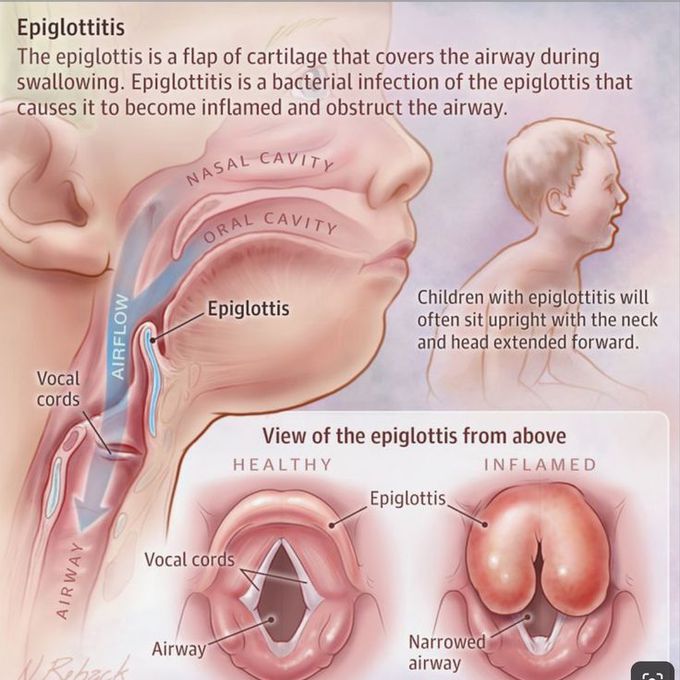 Epiglotttotis