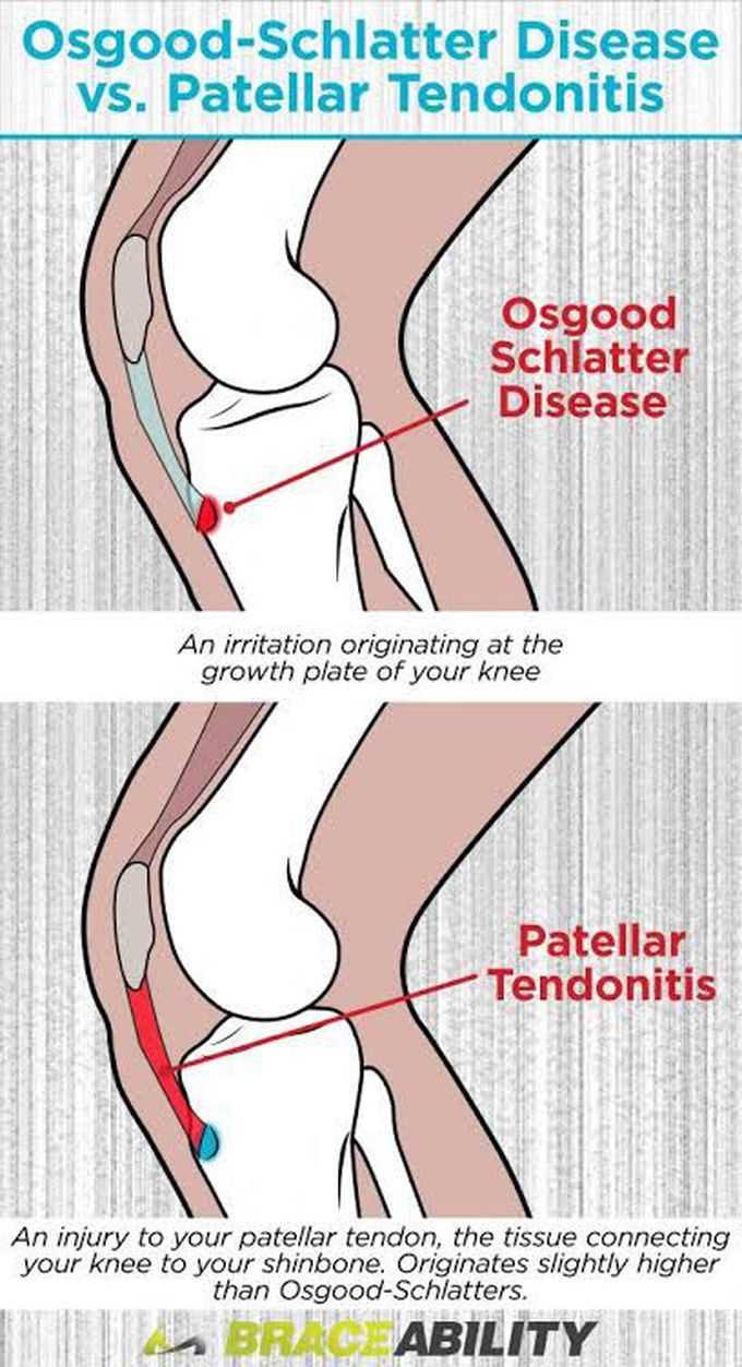 Osgood-Schlatter Disease vs Patellar Tendonitis