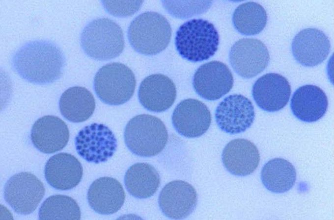 Supravital staining of peripheral blood smear showing golf ball cells(appearance of golf ball).