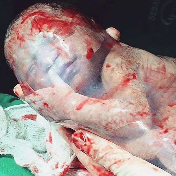 Baby born while still in a fully intact amniotic sac