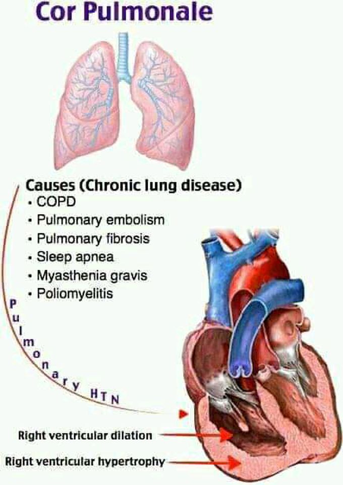 💥#Cor_pulmonale ⬅
is defined as an alteration in the structure and function of the right ventricle (RV) of the heart caused by a primary disorder of the respiratory system. Pulmonary hypertension is often the common link between lung dysfunction and the heart in cor pulmonale. Right-sided ventricular disease caused by a primary abnormality of the left side of the heart or congenital heart disease is not considered cor pulmonale, but cor pulmonale can develop secondary to a wide variety of cardiopulmonary disease processes. Although cor pulmonale commonly has a chronic and slowly progressive course, acute onset or worsening cor pulmonale with life-threatening complications can occur.
💥#sign_and_symptoms◀️
Dyspnea
Tacycardia
Peripheral edema
chest pain
Cyanose
Palpetation
 coughing 
wheezing