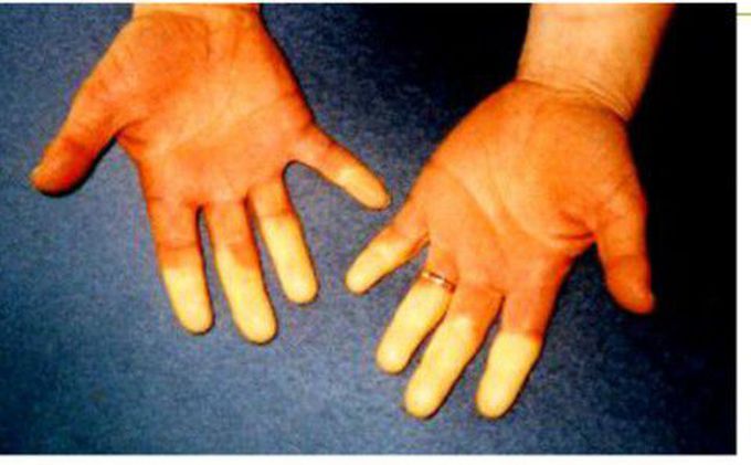 Raynaud's phenomenon