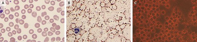 Morphologic Changes in Erythrocytes in Hypertriglyceridemia