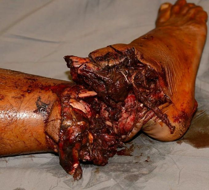Sub-total traumatic amputation