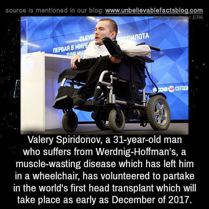 Worlds First Head Transplant