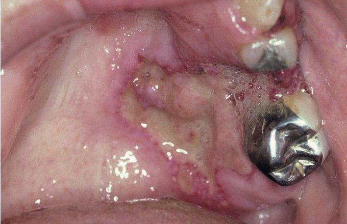 Wegener Granulomatosis