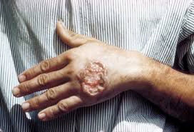 Symptoms of leishmaniasis