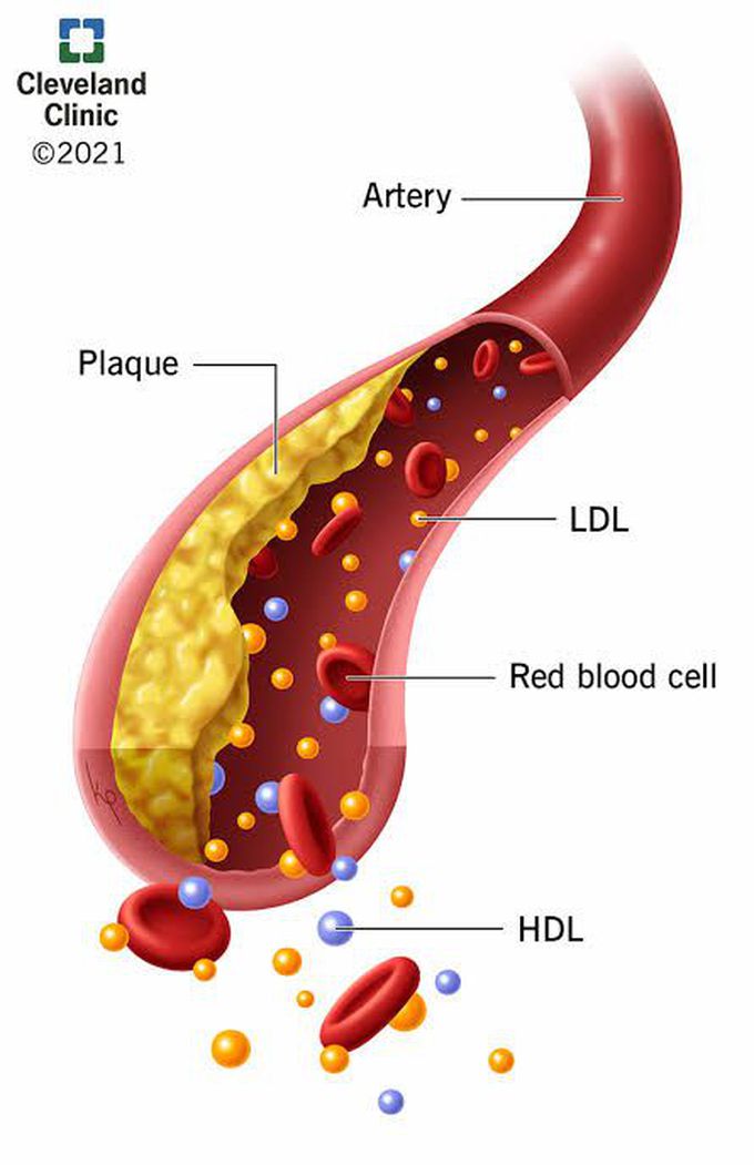 Hyperlipidemia Medizzy 6972