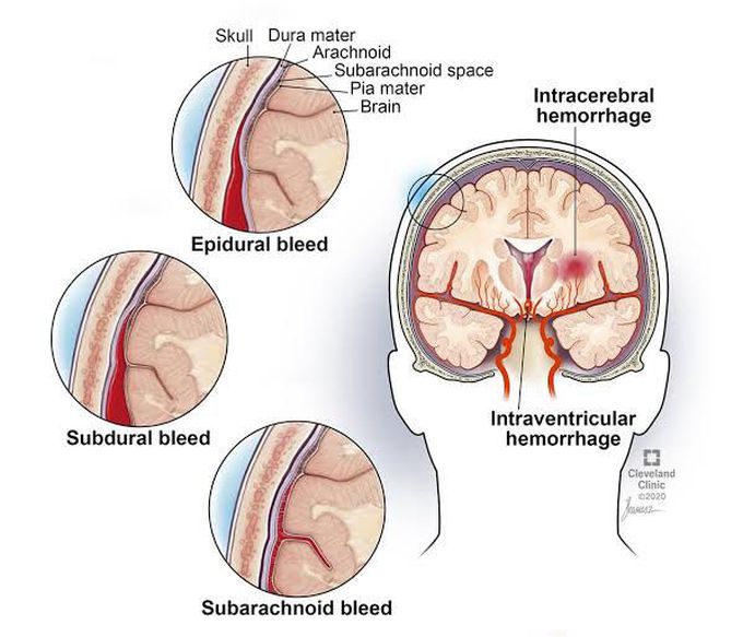 Epidural hematoma
