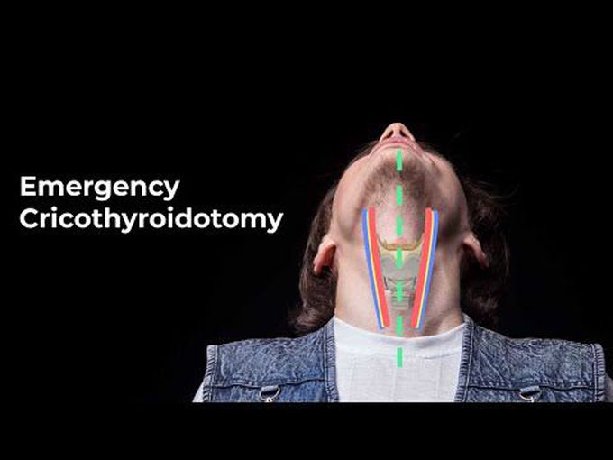 Emergency Cricothyroidotomy