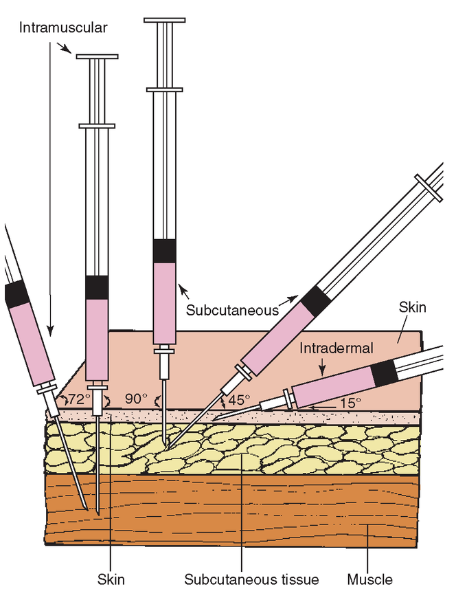 Angles of insertion