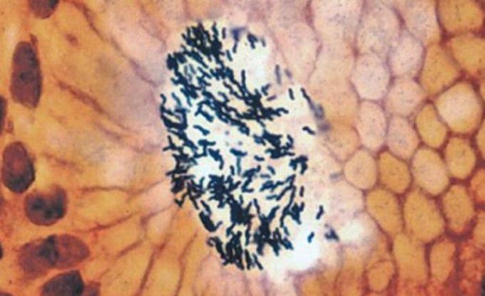 Helicobacter pylori in association with gastric mucosa