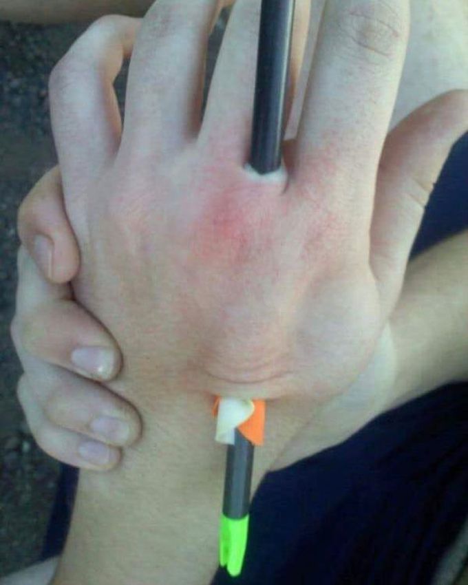A case of accidental, self-inflicted injury to the hand from shooting a bow and arrow.