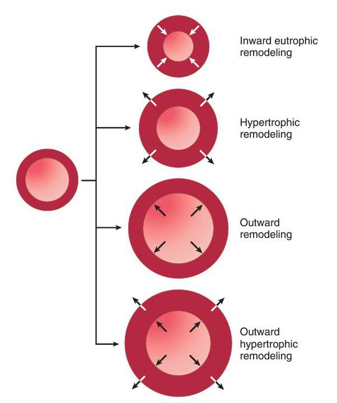 Vascular remodeling