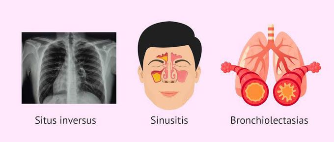 Kartagener syndrome symptoms