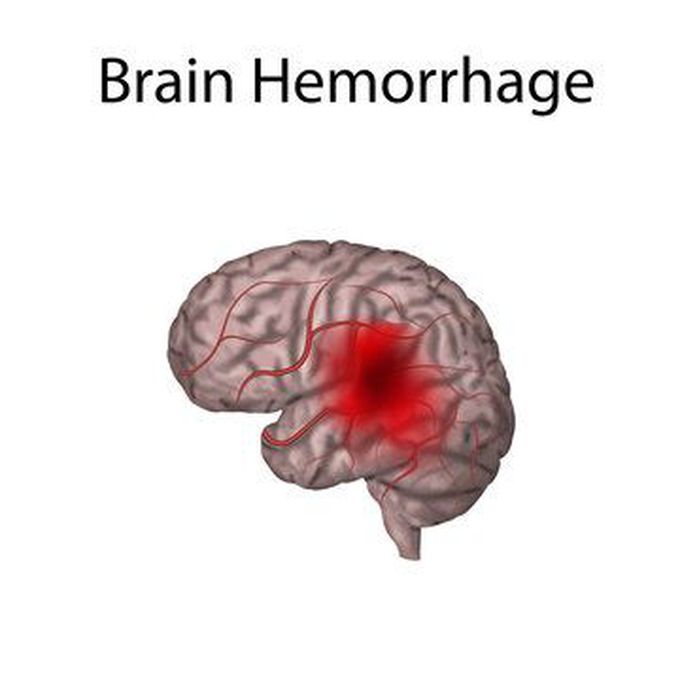 Brain haemorrhage