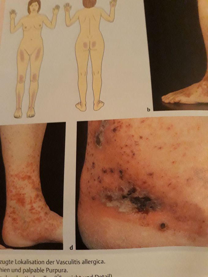Vasculitis allergica