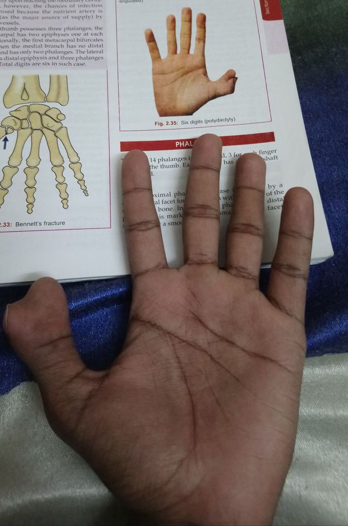 My Polydactyly Hand