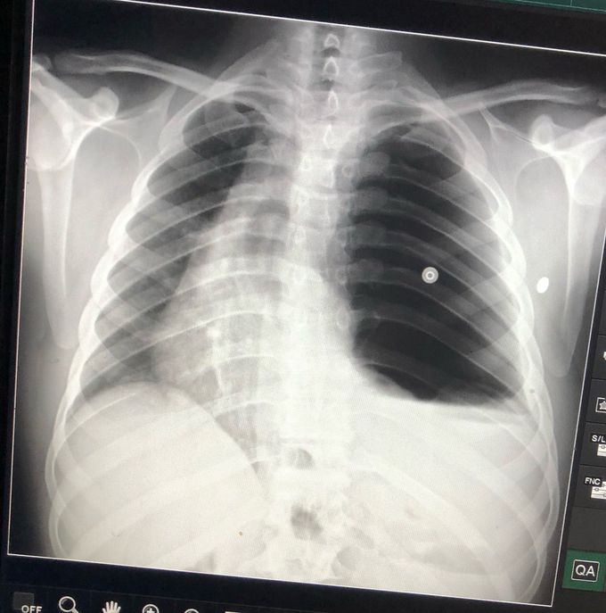 A case of hydropneumothorax