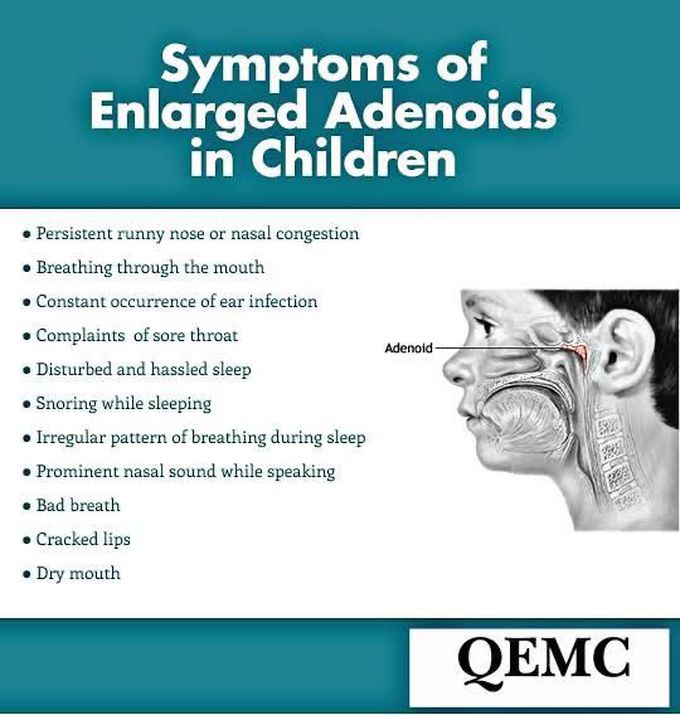 Adenoid symptoms