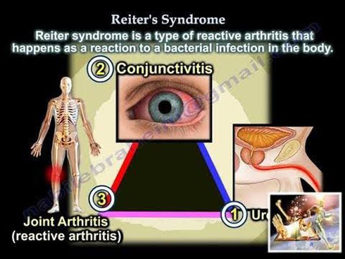 Reiters syndrome