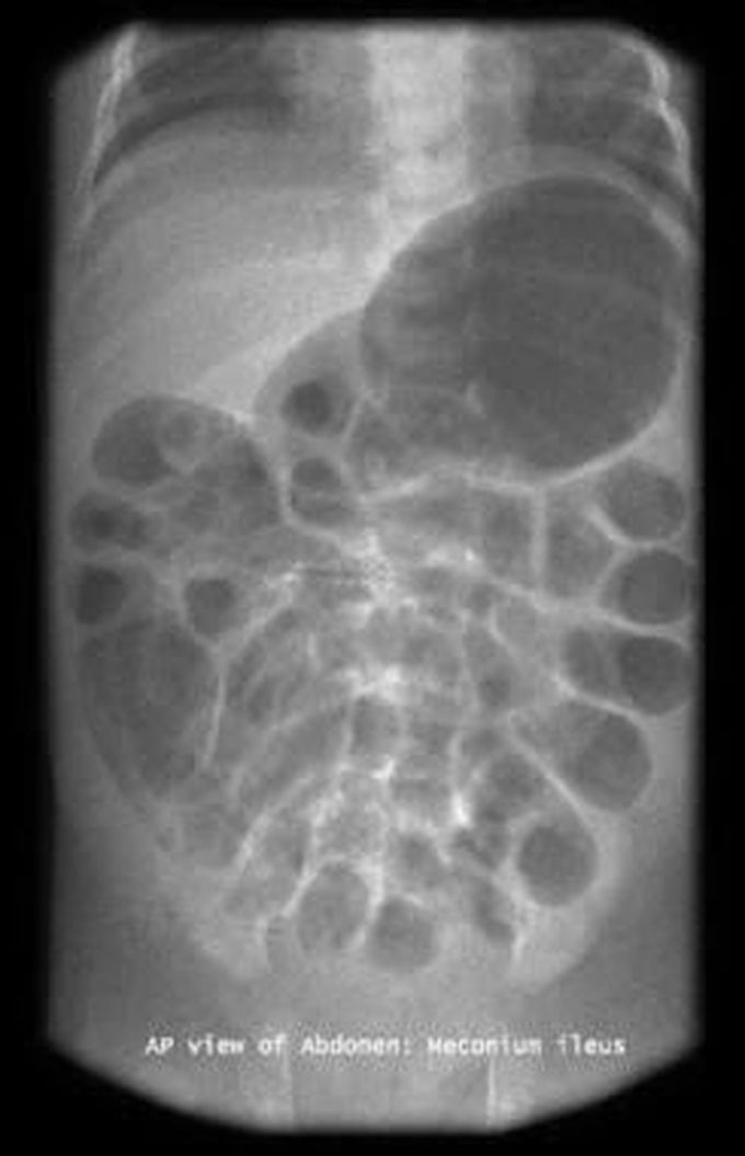 Meconium ileus