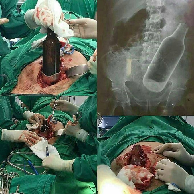 A beer bottle won't do good for your rectum!  