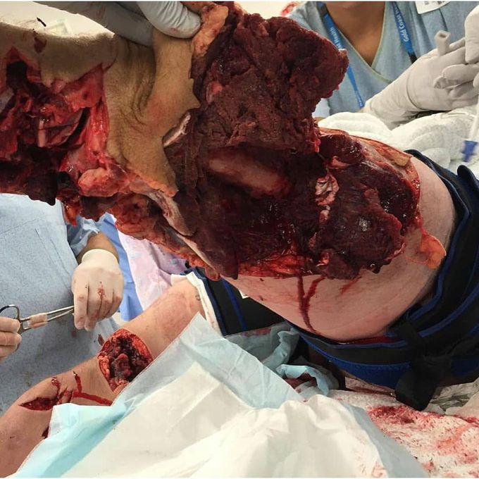 Shark attack injuring both legs⚠️ 
