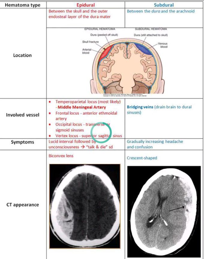 Difference between Extradural and subdural Hematoma
