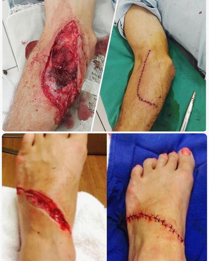 Surgical sutures