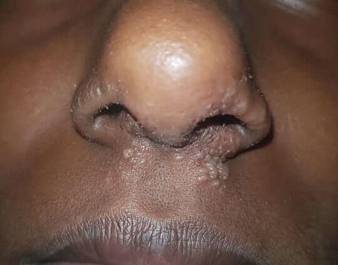 15yrs/F lesion present since 2says plus itching dianosis and RX ???PLZZZ