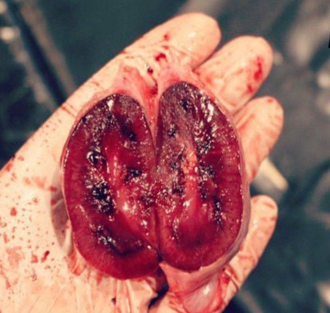 Kidney dissection ...