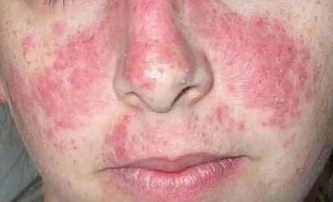 Butterfly Rash