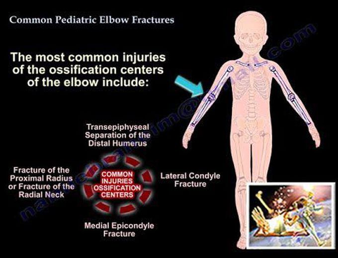 Common Pediatric Elbow Fractures - Everything You Need To Know - Dr. Nabil Ebraheim