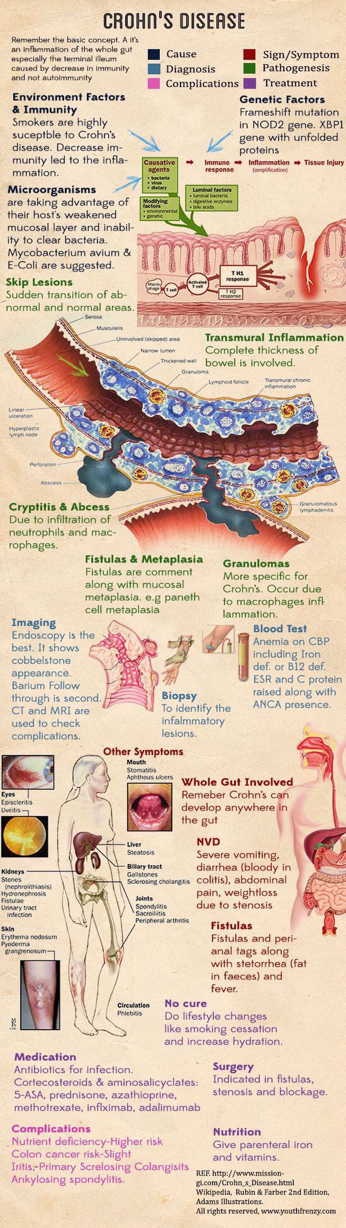 Crohn‘s disease
