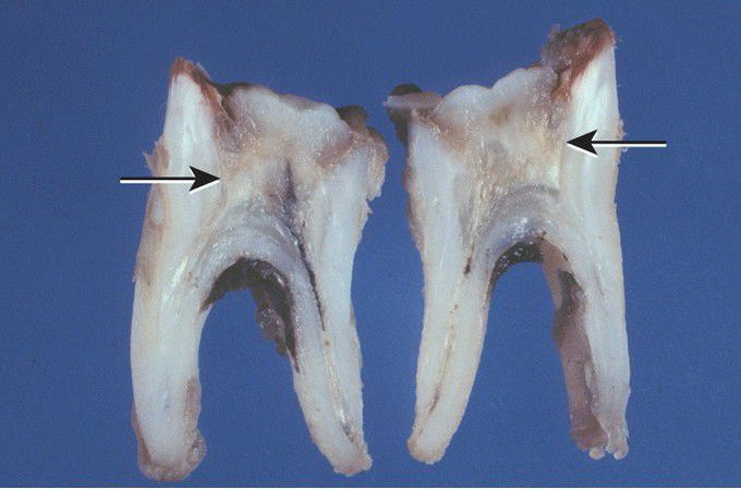 Chronic Hyperplastic Pulpitis