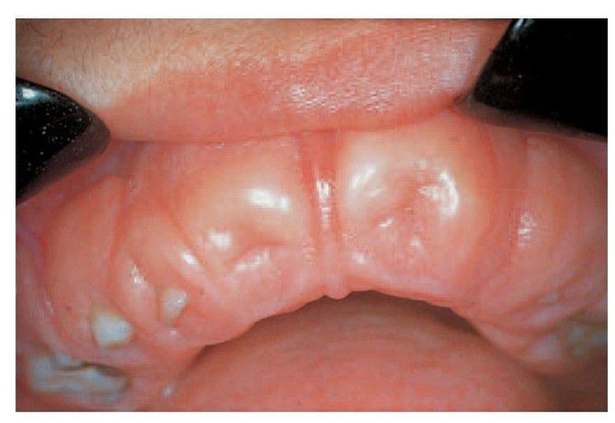 Hereditary gingival fibromatosis