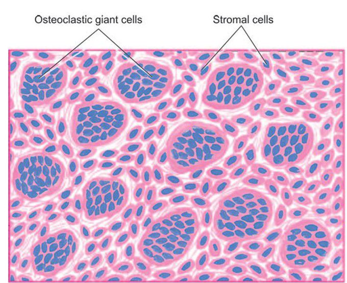 Osteoclastoma