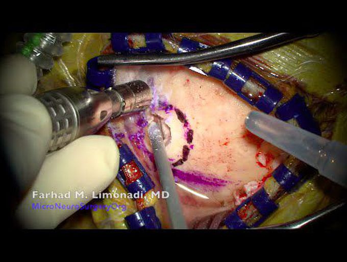Brain surgery : Surgical resection of brain tumor with continued growth after  radiation treatment.