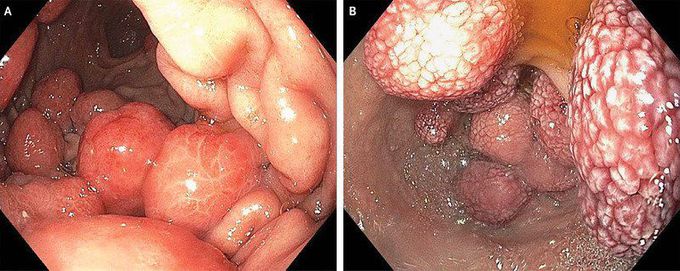 Myeloid Sarcoma Of Gastrointestinal Tract