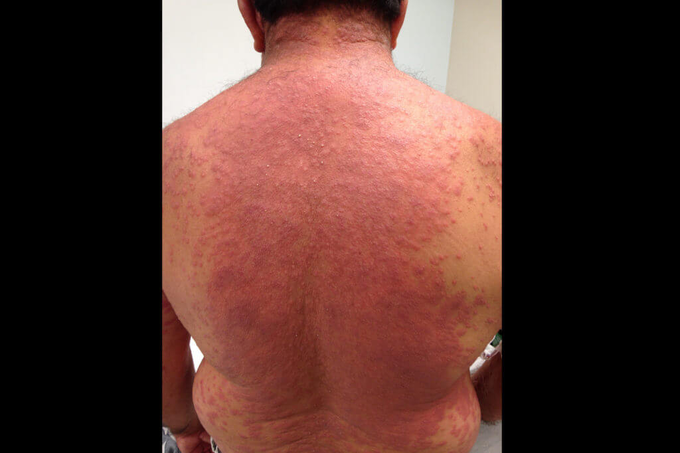 DRESS Syndrome - Rare Acute Dermatologic Emergency