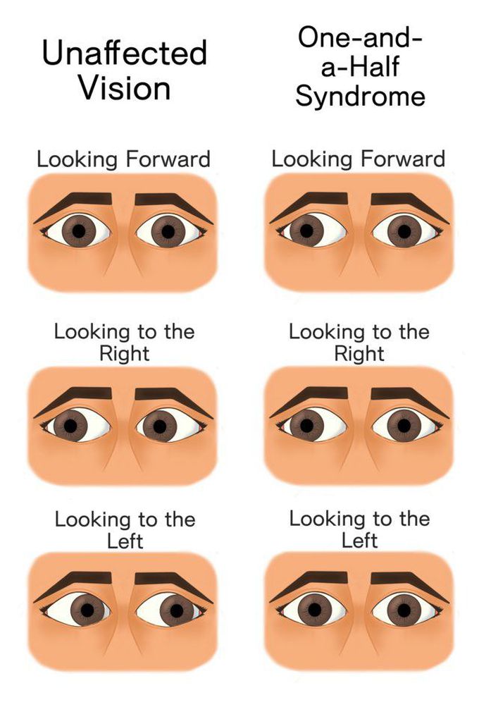 Difference between normal vision and one and a half syndrome