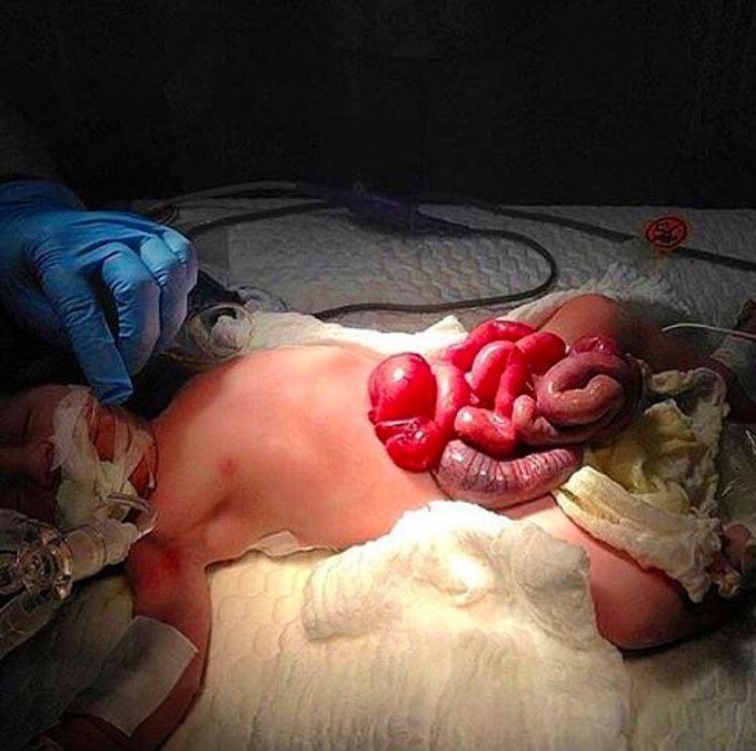 Gastroschisis